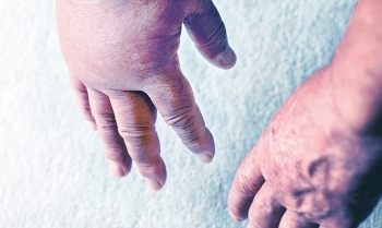 Día Mundial del AEH