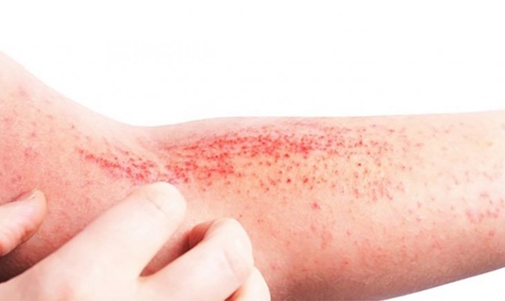 Día Mundial de la Dermatitis Atópica