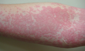 1 de Octubre: Día Mundial de la Urticaria Crónica