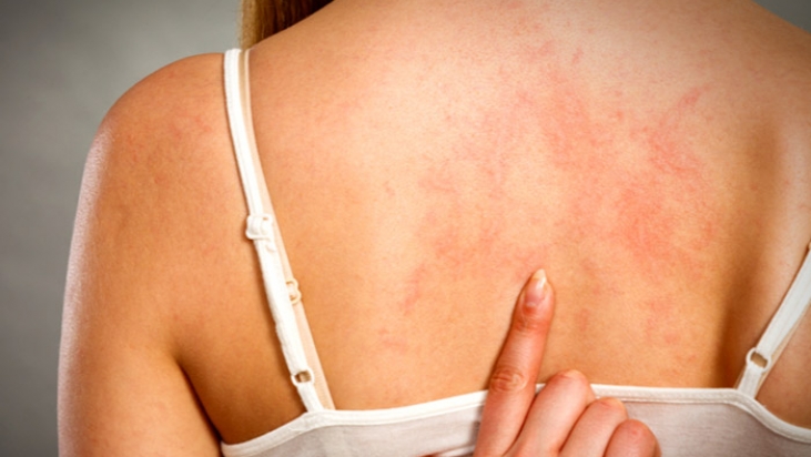 1 de octubre: Día Mundial de Concientización acerca de la Urticaria Crónica